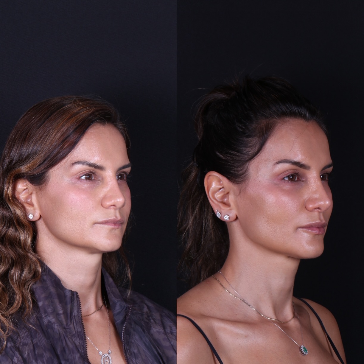 Não é sobre quantos mLs foram utilizados.
É sobre saber onde, por que e quanto é necessário.

A estética facial...