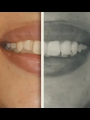 Correção de maxila com uso de mini implantes, caso em tratamento ainda 💎💎 #miniimplante #ortodontia